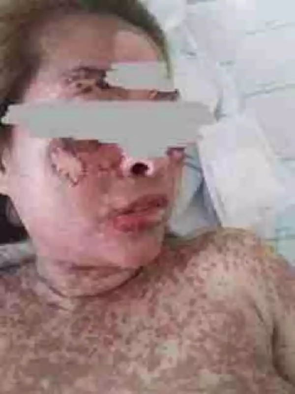 Graphic Photos: Woman Dies After Consuming Herbal Drugs She Bought on Facebook to Lighten Her Skin